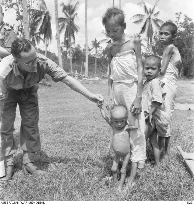 Nawi, Sanina and their children, suffering from malnutrition, malaria and scabies, in Beaufort Civil Hospital set up under Australian Army administration. (AWM 111823)